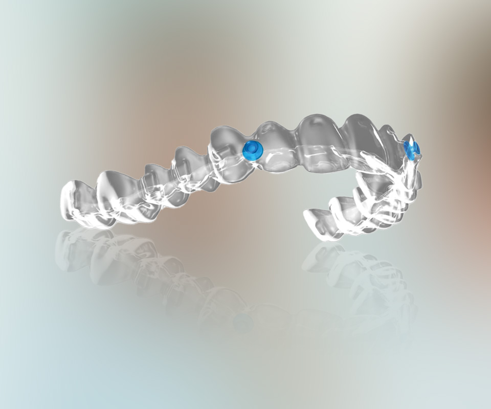 What are Angel Aligners?