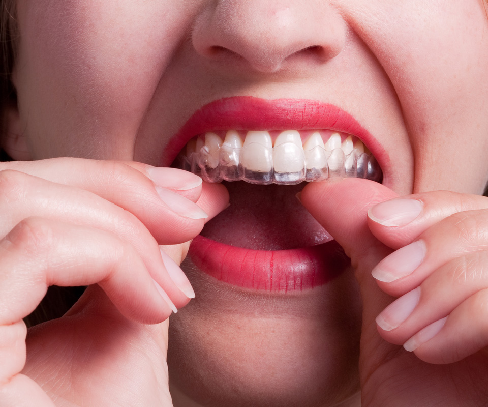What are the benefits of Angel aligners?